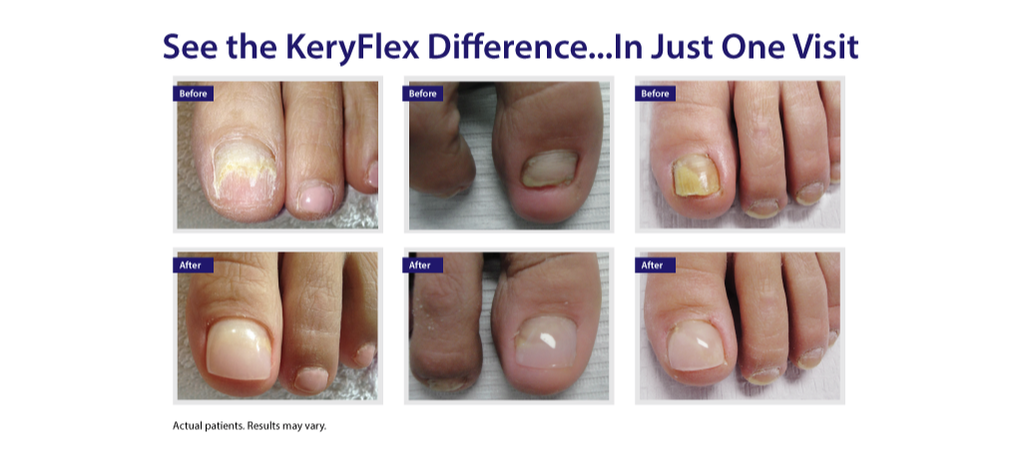 KeryFlex Nail Restoration System